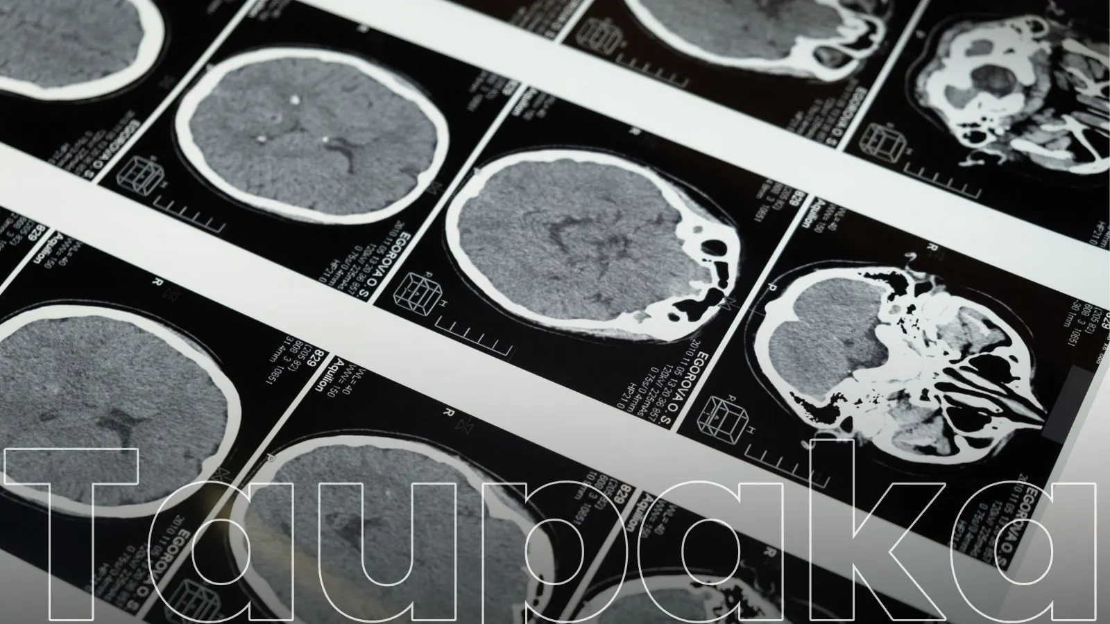 Epilepsia: gaixotasun neurologiko ohikoenetakoa